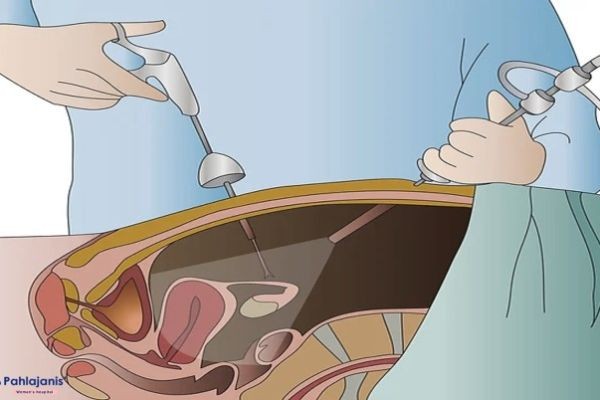 Recovery After Diagnostic Hystero Laparoscopy: Tips for Faster Healing