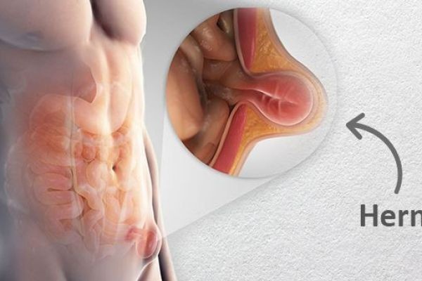 Best Laparoscopic Hernia Surgery in Guwahati: Get Advanced and Painless Treatment | GI Surgery