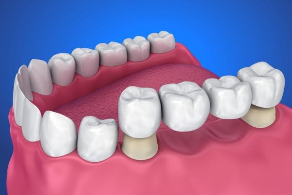 Restore Your Smile with Dental Bridges: A Complete Guide by a Kansas City Dentist