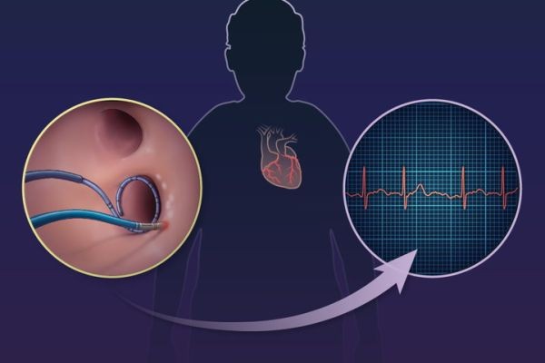 Atrial Fibrillation (Afib) Market growth driven by innovative therapies, aging population, and awareness