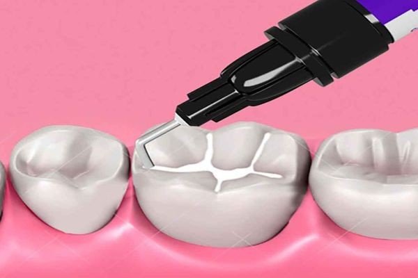 Dental Sealants Market Insights on Growth Drivers, Technological Innovations, and Future Industry Prospects
