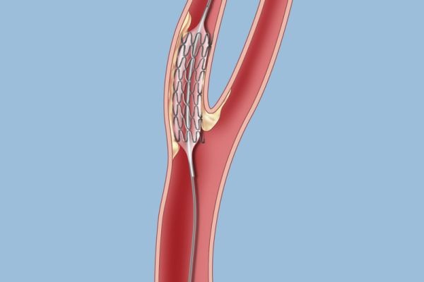 Angioplasty Balloons Market Analysis Explores Innovation, Future Demand, Regional Trends, and Growth Potential