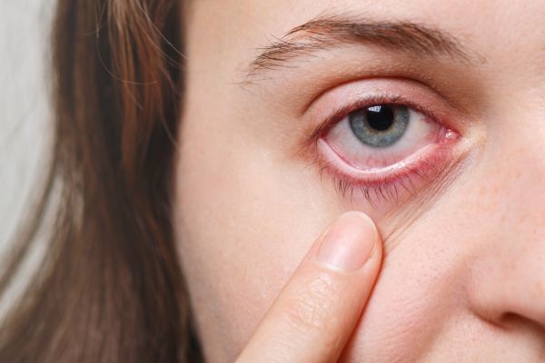 Red Eye: Causes, Symptoms, and When to See a Doctor