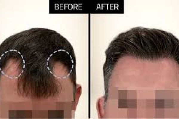 Hair Restoration Market gaining growth from enhanced awareness campaigns on hair health management