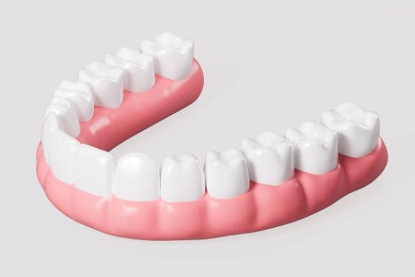 Who Is a Good Candidate for Implant-Supported Bridges?