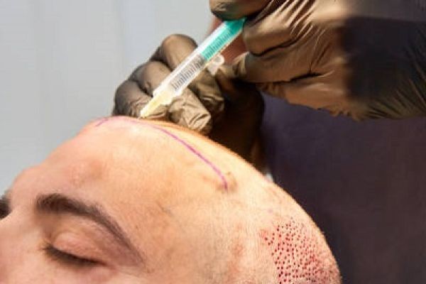 Hair Transplant in Islamabad: The Smart Choice for Natural Hair Restoration