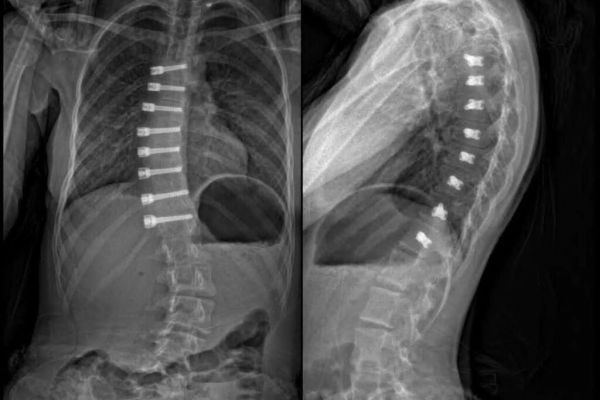 Pediatric Scoliosis Fort Lauderdale