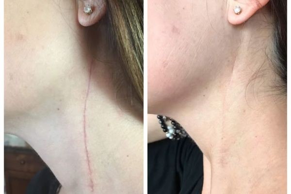 Stretch Mark Removal That Blends Science with Skin Care Expertise