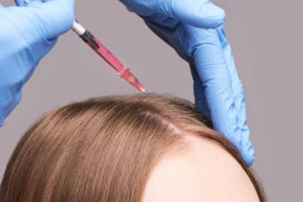PRP Hair Treatment for Managing Hair Loss Naturally