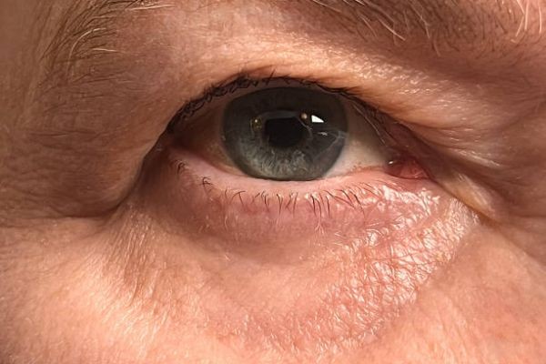 Eyelid Surgery in Islamabad: Reclaim Youthful Eyes with Expert Care