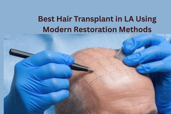 Best Hair Transplant in LA Using Modern Restoration Methods