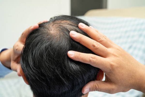 Exosomes Therapy for Hair Loss and Scalp Revitalization