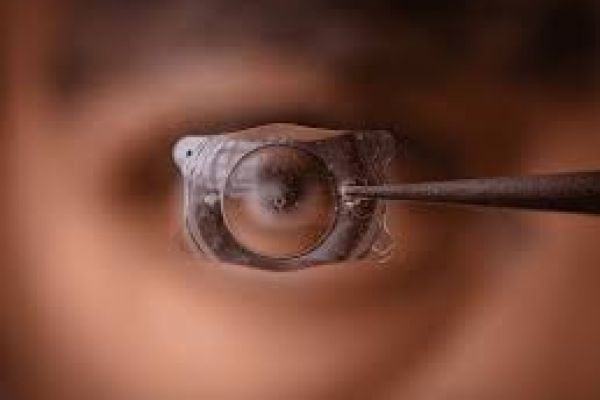 The Implantable Collamer Lens Market Trends Examining Consumer Preferences And Adoption Across Regions