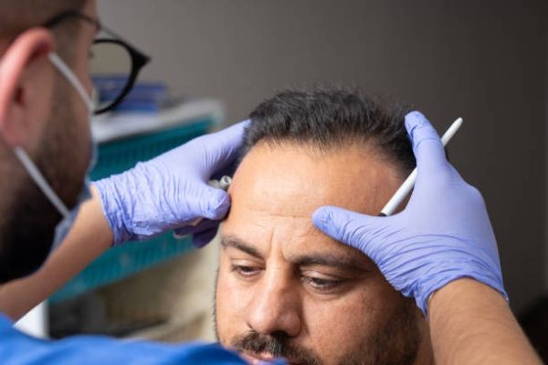 A New Standard of Hair Transplant in Riyadh for Men and Women