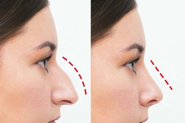 Best Rhinoplasty Surgeon Dubai for Safe and Reliable Nose Surgery