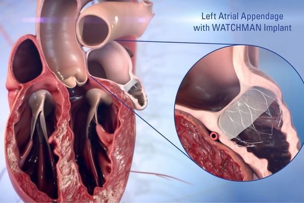 Atrial Fibrillation Device Market Evolution Supported by Continuous Research and Clinical Advancements in Cardiology.