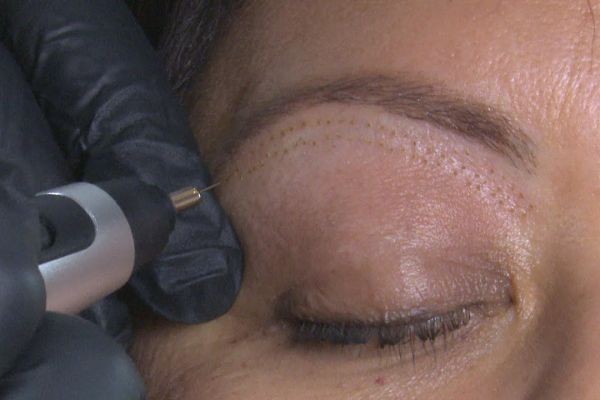 Plasma Pen Treatment Process Explained – Islamabad Clinics