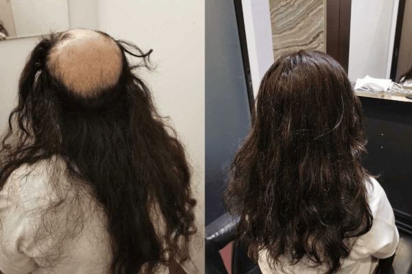 Hair Replacement Singapore