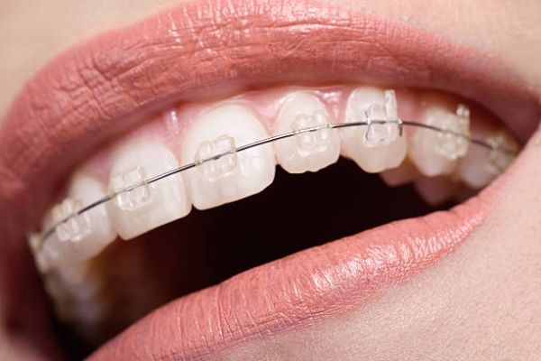 Get a Perfect Smile with Teeth Braces in Islamabad
