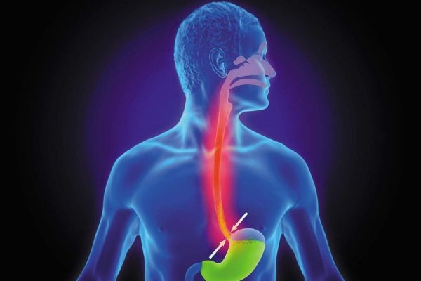 Dubai Overview of Acid Reflux Treatment and Prevention