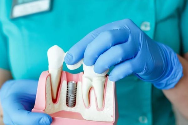 Dental Implant Treatments in Delhi: Achieve a Perfect Smile with Full Mouth Implants