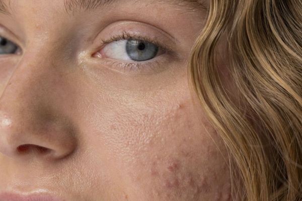 Acne-Free Confidence: Transform Your Skin Today