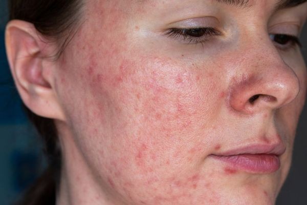 How to Fade Sunspots in Just Weeks