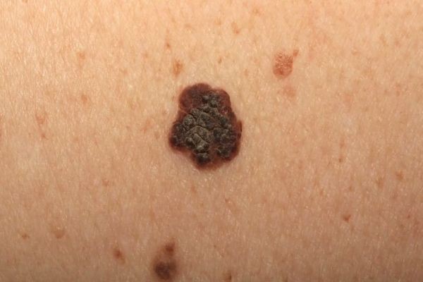 Precision Birthmark Removal for Confident Skin