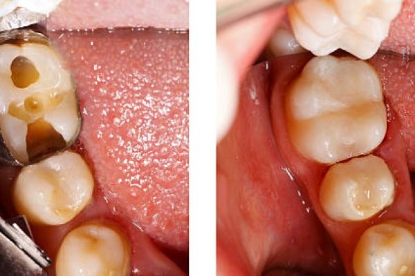 Dental Fillings in Islamabad: Restore Teeth and Prevent Future Decay