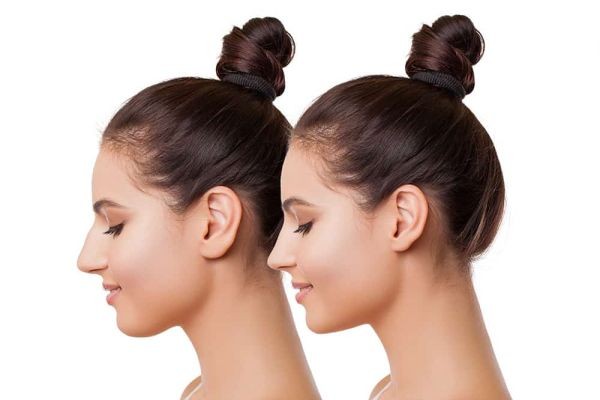 How Can Rhinoplasty price Bring Out the Best Features in Your Face