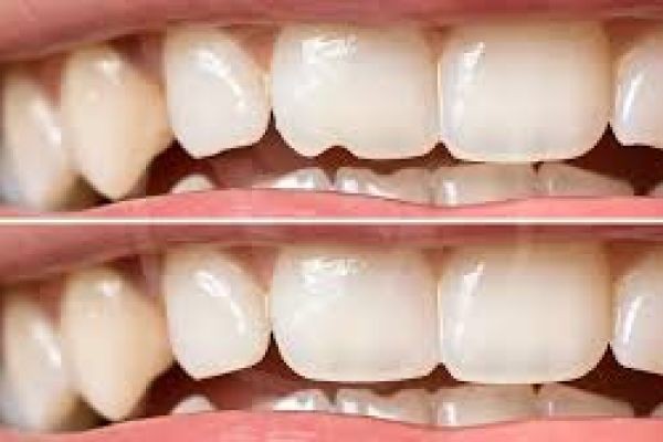 Perfect Your Smile Quickly with Dental Bonding