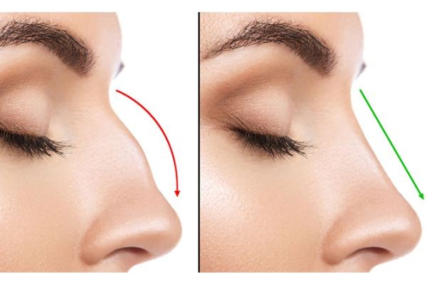 Best Rhinoplasty in Lahore