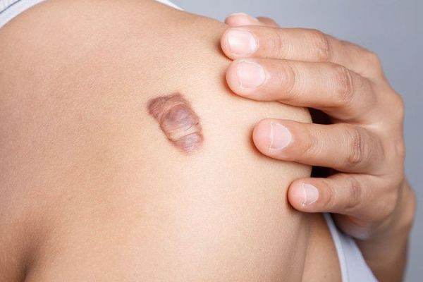 إزالة الثآليل بدون ألم أو آثار جانبية