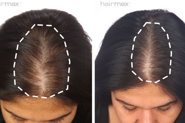 Royal Clinic Saudia’s Expert Approach to Hair Recovery