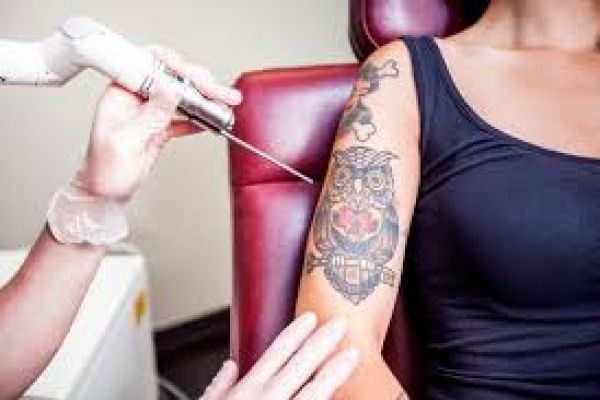 Certified Experts for Tattoo Removal in Islamabad You Can Trust