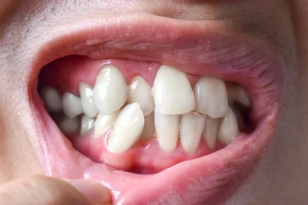 What to Wear to Your Tooth Removal in Dubai Appointment)
