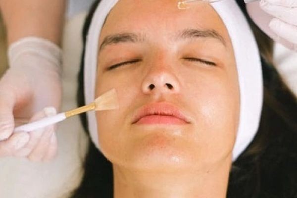 Can chemical peels be done on the back or chest?