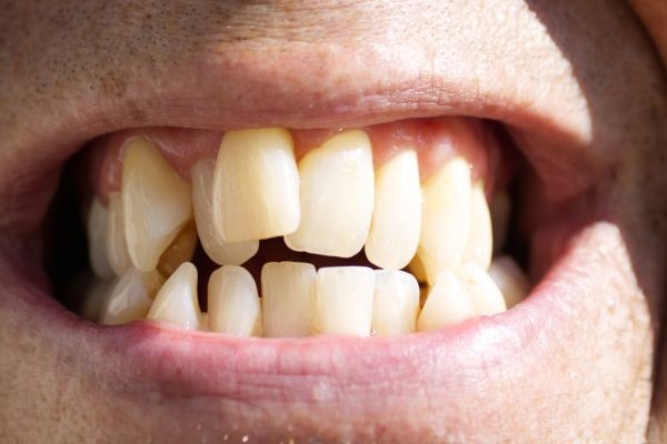 When to Start Crooked Teeth Treatment for Teens in Dubai