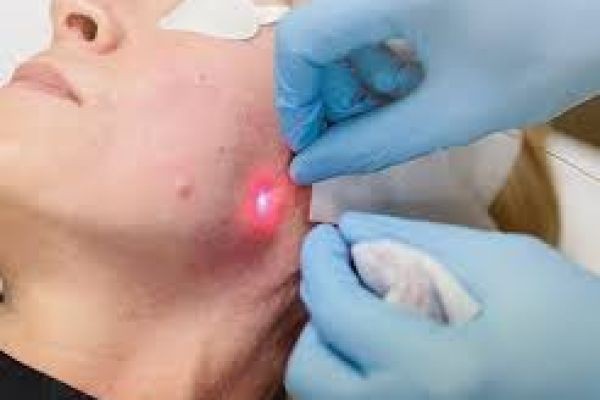 Rejuvenate Your Look: Why Endolift is the Perfect Solution for Early Skin Aging