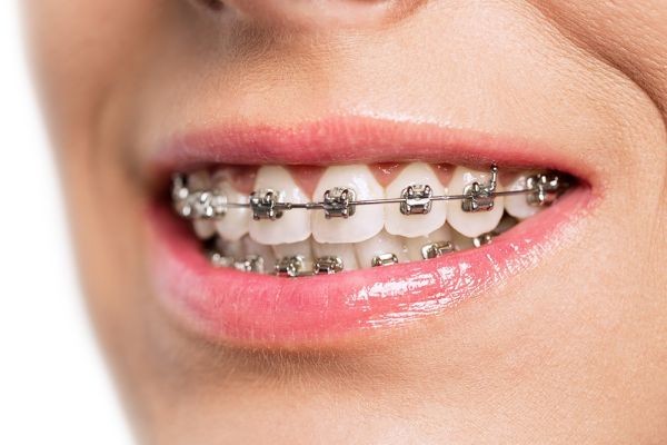Dental Braces and Daily Life: What You Should Know