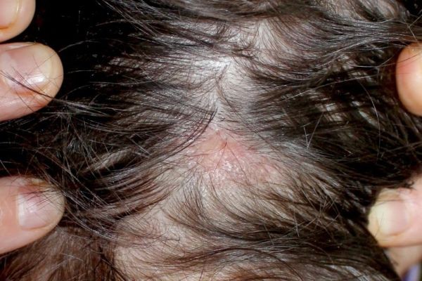 Hair Loss Treatment and Scalp Sensitivity