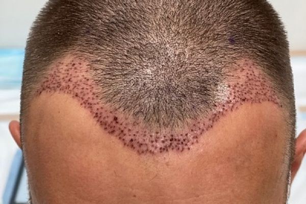 Restoring Confidence: A Guide to Hair Transplants for Genetic Hair Loss in Dubai