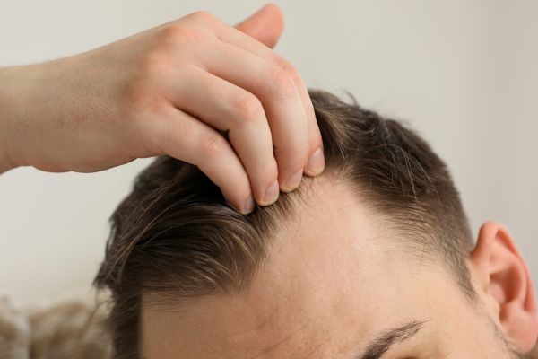 Why Timing Matters for Scarless Hair Transplant in Dubai