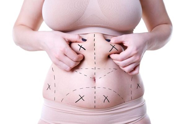 Liposuction vs Tummy Tuck in Islamabad