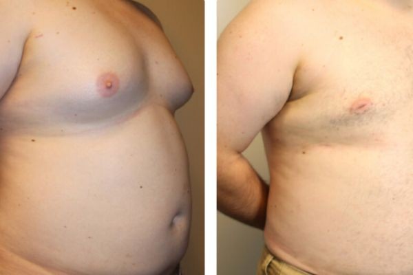 How Different Techniques Affect Gynecomastia Surgery Cost