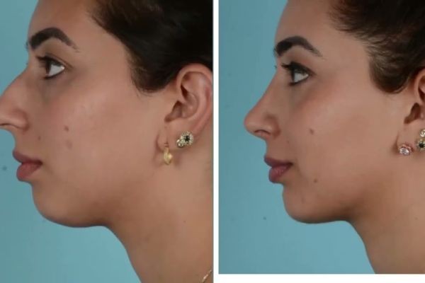 Achieve Symmetry with Professional Rhinoplasty in Islamabad