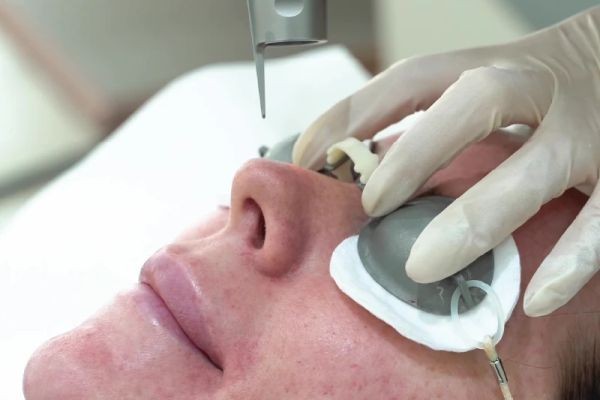 Picosure Laser Treatment for Birthmark Fading: Complete Insights