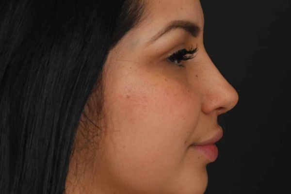 Rhinoplasty in Islamabad: What Makes It a Popular Cosmetic Treatment