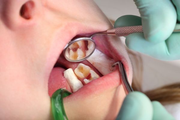 Dental Tooth Filling for Front Teeth: What You Need to Know