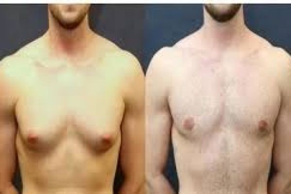 Understanding Gynecomastia Repair: A Path to Renewed Confidence